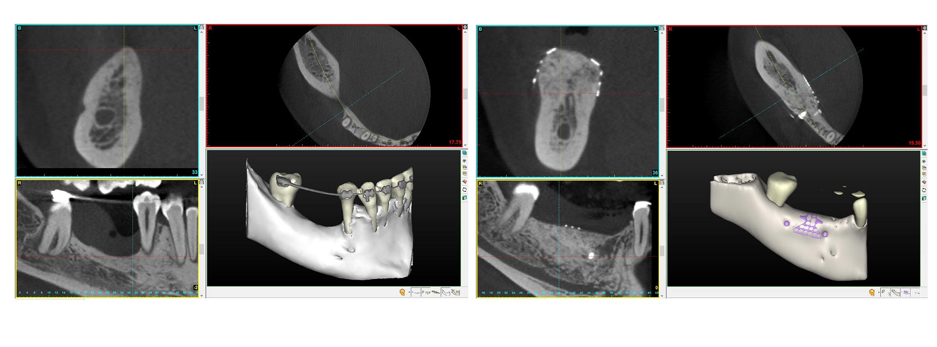 Vertical Guided Bone and Tissue Regeneration (London) 19-20 November 2021 Vertical Guided Bone and Tissue Regeneration (London) 19-20 November 2021