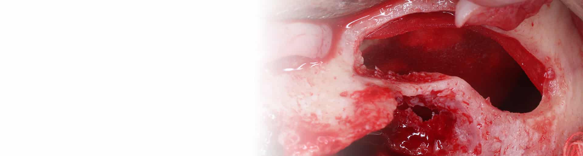 LCIAD Academy | Sinus and Bone Augmentation Hands-on Cadaver Course (3-5 July 2025)