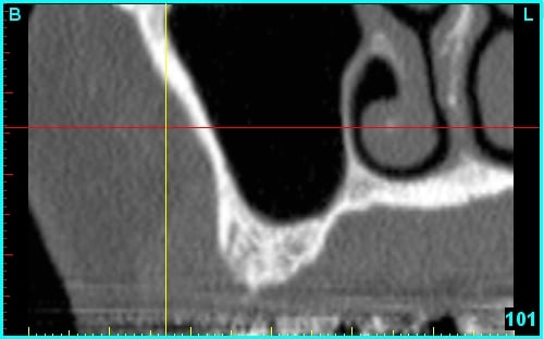 Edentulous_sinus_CBCT